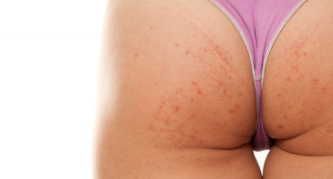 beautykin-Put Butt Acne Behind You | Ask the Skin Care Experts | Beauty Kin