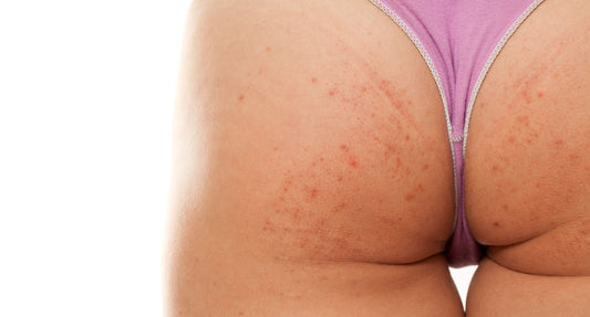 beautykin-article-Put Butt Acne Behind You | Ask the Skin Care Experts | Beauty Kin